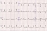 Tachycardia, AF, hypertrophy: What do these ECGs tell us?