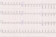 Tachycardia, AF, hypertrophy: What do these ECGs tell us?