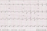 ECG quiz: Possible acute coronary syndrome and fast palpitations