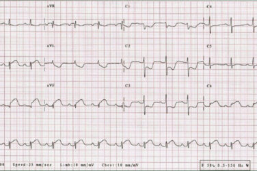 ECG quiz: Possible acute coronary syndrome and fast palpitations