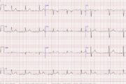 ECG quiz: Palpitations, irregular pulse on diabetic review and blackouts
