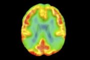 Pulse Reference Masterclass: Dementia