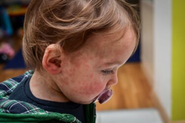 Measles cases in London have caught up with West Midlands