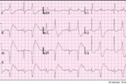 ECG quiz: What do these extra QRS complexes mean?