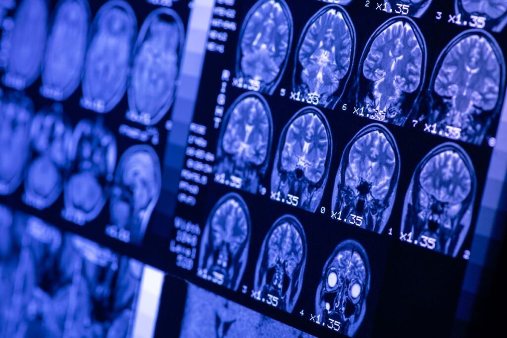 Migraine - investigations of headache