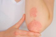 Sponsored CPD: Eczema and psoriasis – the mental health link
