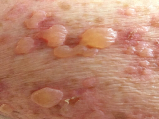 Once in a lifetime: Stevens-Johnson Syndrome