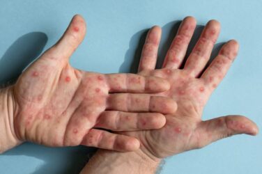 Mpox case reported in England with no travel or close contact history