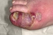 Non-Covid clinical crises: Diabetic foot