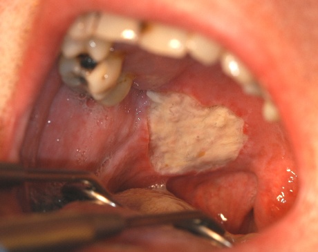 Major aphthous ulcer on the soft palate