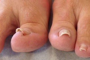 Ingrown toenail - image 4 - SUO