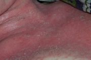 Non-Covid clinical crises: ​Erythroderma