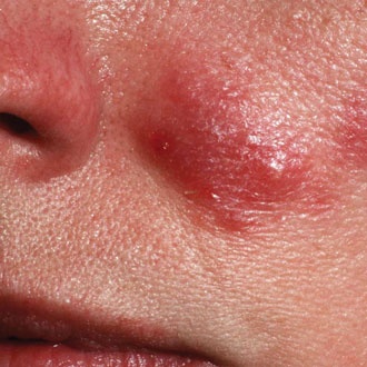 Nodular acne - SUO