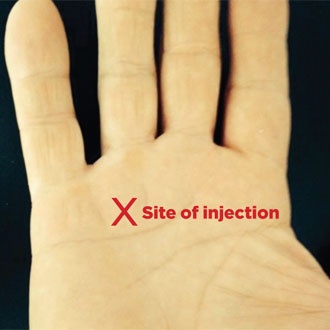 Trigger finger - site of injection - SPL - SUO