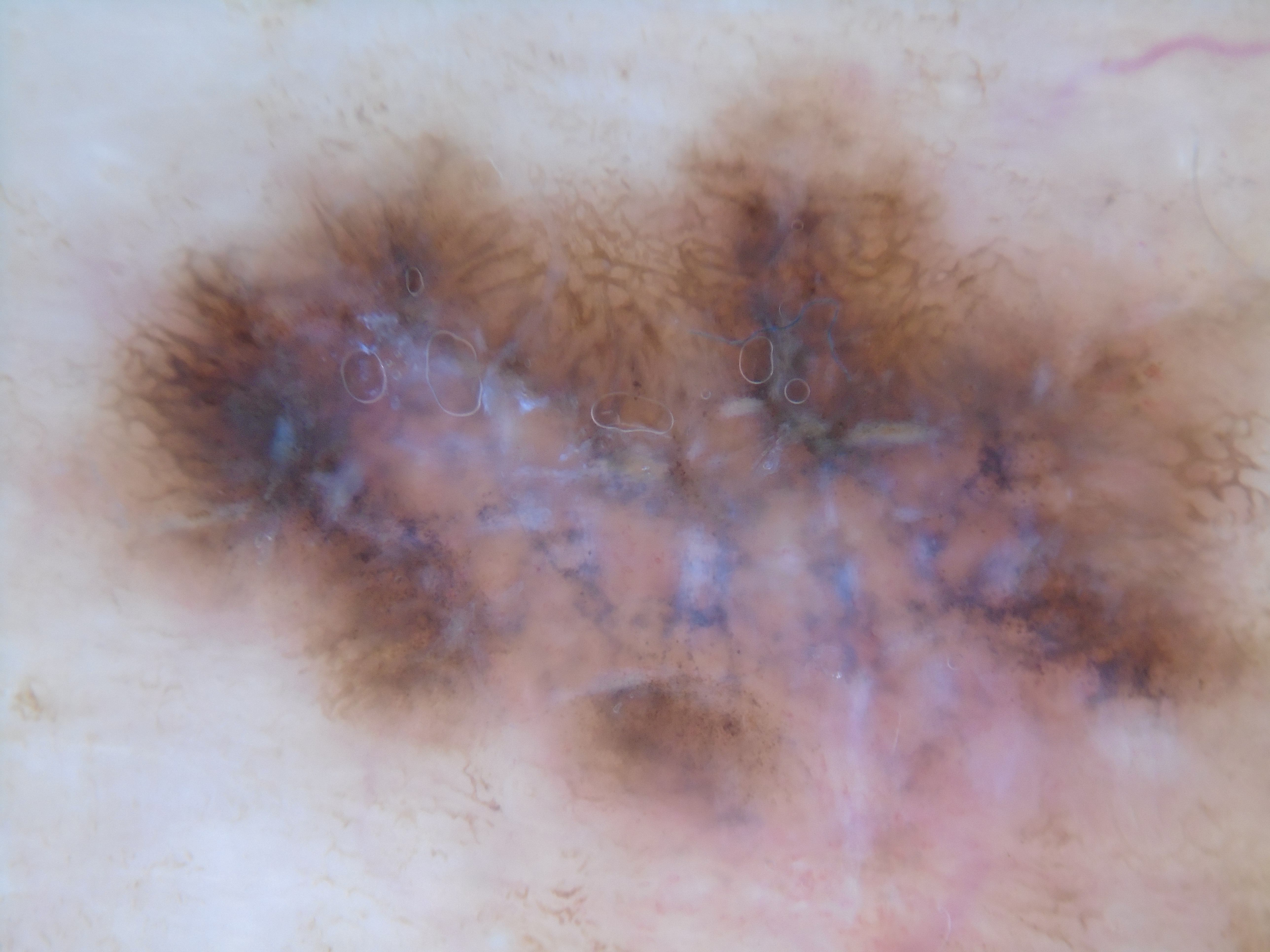 melanoma with chaos, shiny white streaks, multiple colours
