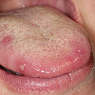 The information – Aphthous ulcers