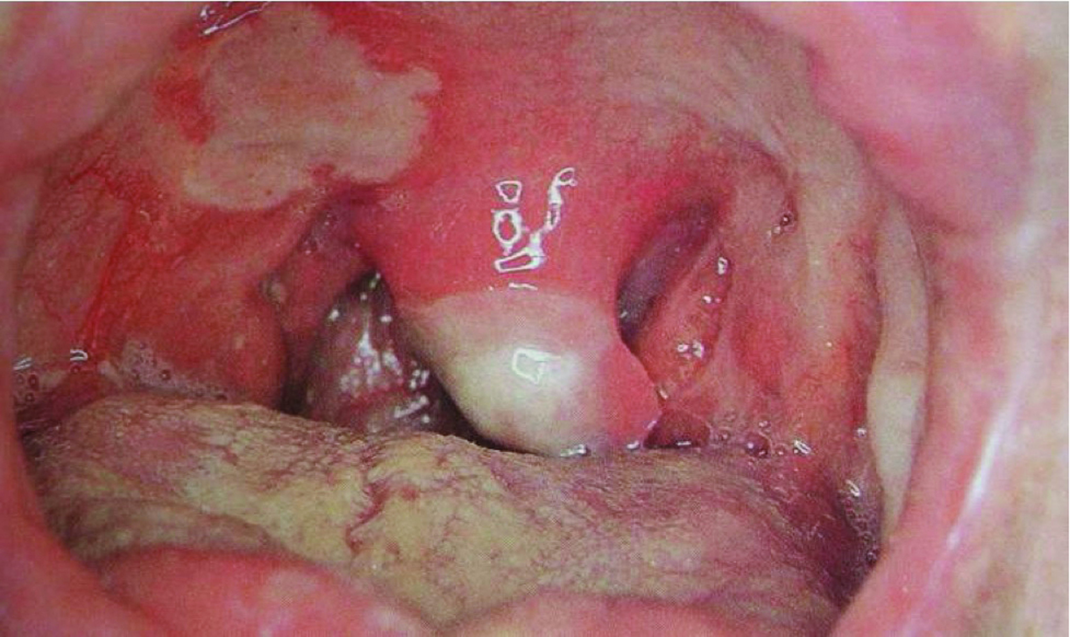 ulcers with scarring