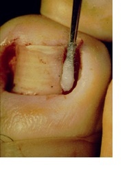 Ingrown toenail - image 1 - SUO