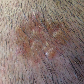9 ttt skin lesions 330x330px