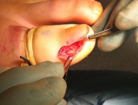 Ingrown toenail - image 2 - SUO