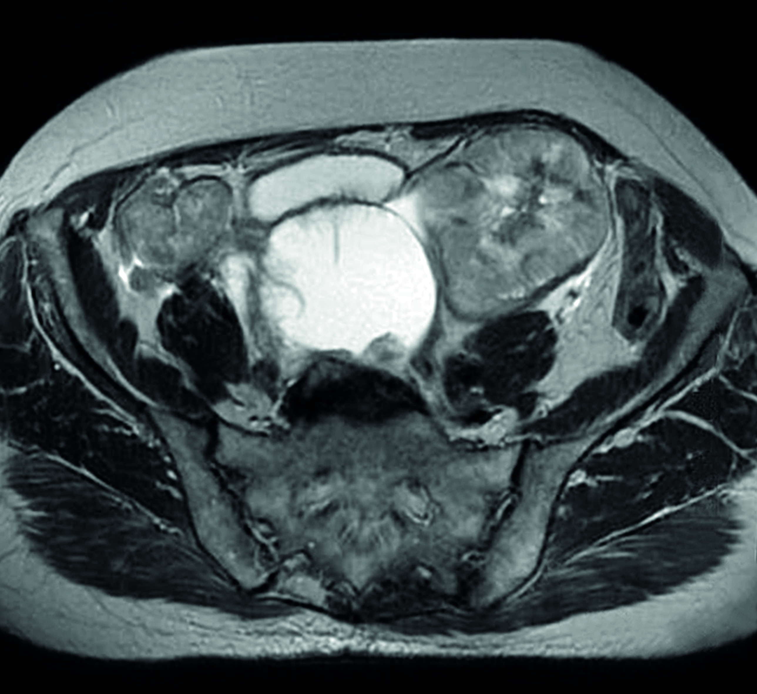 c0345656 bilateral ovarian cancer, mri scan spl