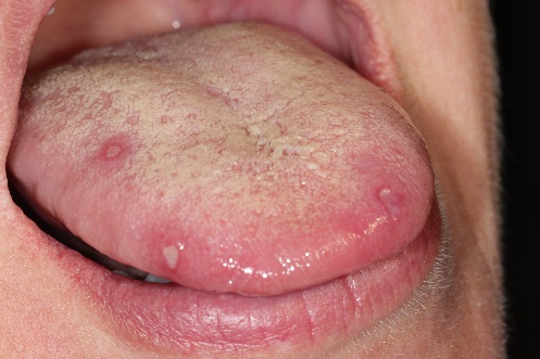 Minor aphthae on the tongue