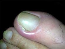 Ingrown toenail - image 5 - SUO