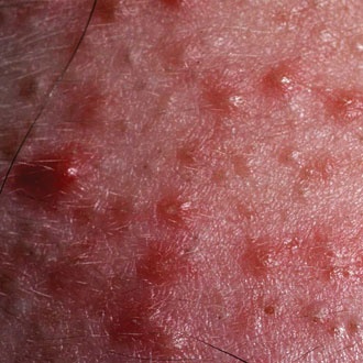Papulopustular acne - SUO