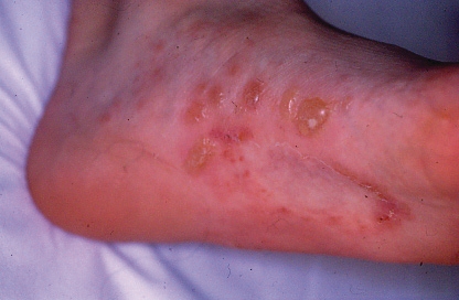 palmoplantar pustular psoriasis nhs kék és piros foltok a lábakon
