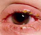 Managing common eye conditions (1 CPD hour)