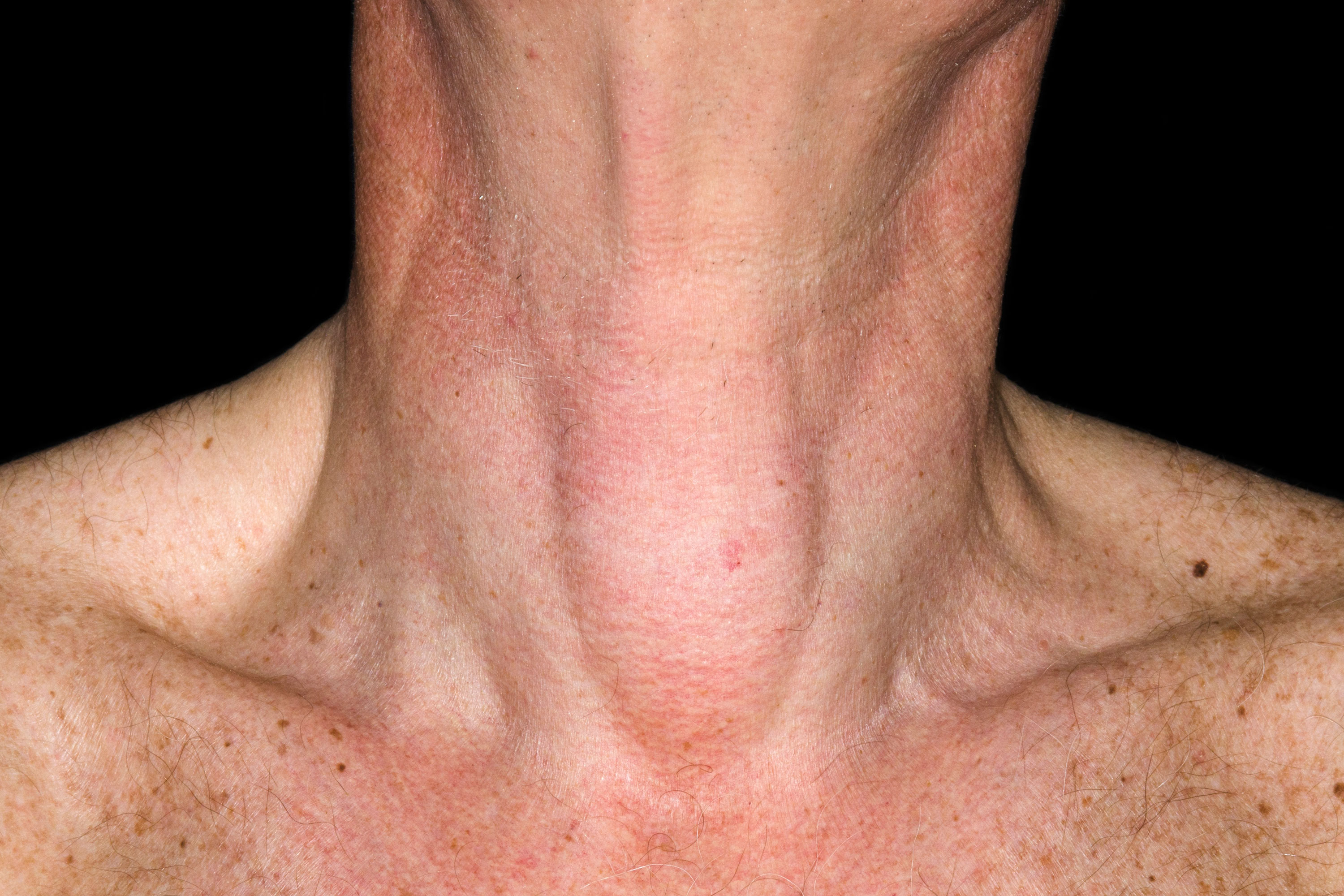 cystic nodule on the thyroid gland 3x2