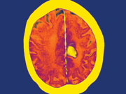 brain haemorrhage ct scan spl 180x135