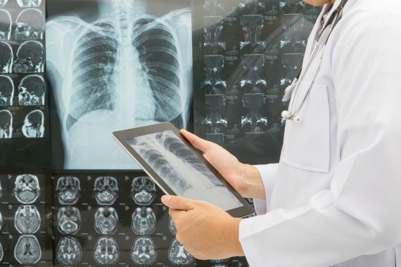 New GP risk tool could identify patients for national lung cancer screening programme