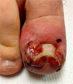Ingrown toenail - image 7 - SUO