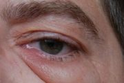 Ten top tips – Eyelid disorders