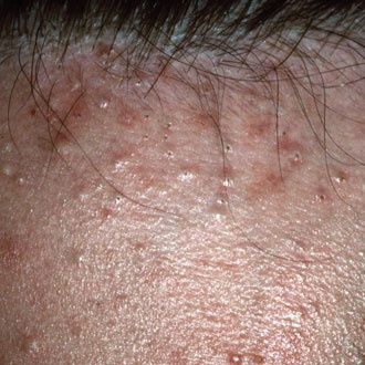 Comedonal acne - SUO
