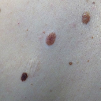 4 ttt skin lesions 330x330px