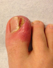 Ingrown toenail - image 6 - SUO