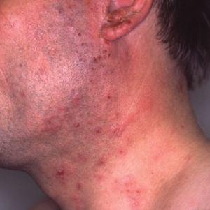 Impetiginised Atopic Eczema Vs Eczema Herpeticum Pulse Today