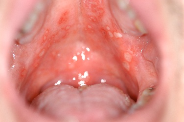 Herpetiform aphthous ulcers on the palate/soft palate with marked surrounding erythema