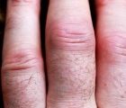 Non-Covid clinical crises: New inflammatory arthritis or flare up of existing