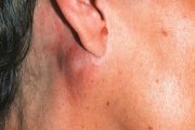 Head and neck clinic – neck lumps