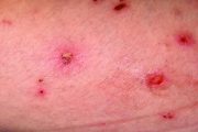 Non-Covid clinical crises: Very severe eczema in children