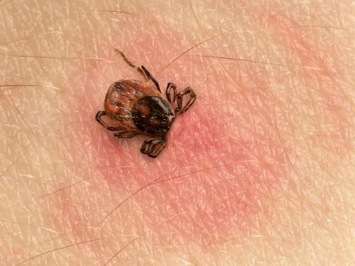NICE: GPs ‘should consider’ antibiotics for Lyme disease without test result